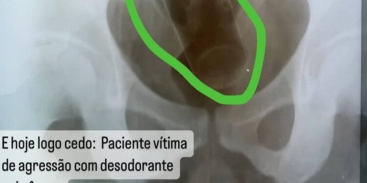 Prefeitura demite médico que vazou raio-X de paciente que inseriu desodorante no ânus, na Paraíba